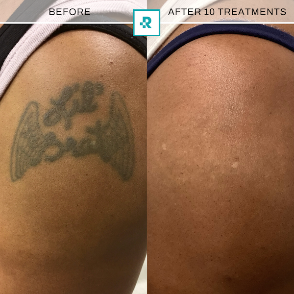 tattoo removal